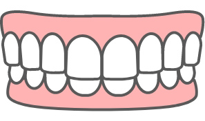 上の歯が下の歯で隠れている過蓋咬合のイラスト